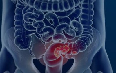 Novo exame para rastrear câncer de intestino é adotado pelo SUS