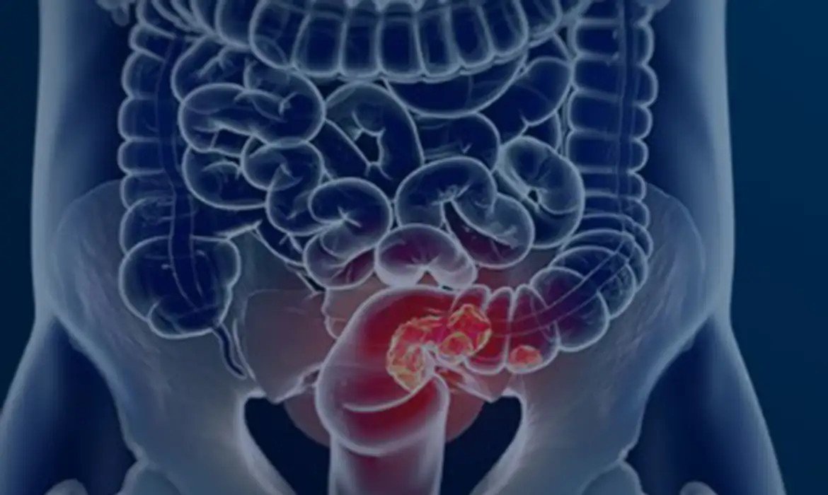 Novo exame para rastrear câncer de intestino é adotado pelo SUS