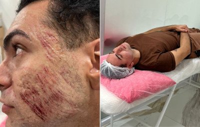 Peeling de fenol: Substância proibida pela Anvisa ganha novas regras do CFM após morte de paciente