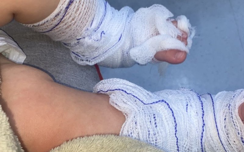Bebê de 11 meses fica com queimaduras após banho em creche municipal de Campo Bom | abc+