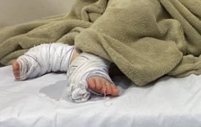 Servidora é demitida e Campo Bom abre sindicância para apurar caso de bebê que teve queimaduras em creche
