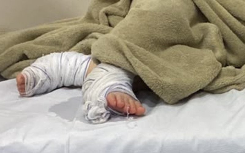 Servidora é demitida e Campo Bom abre sindicância para apurar caso de bebê que teve queimaduras em creche