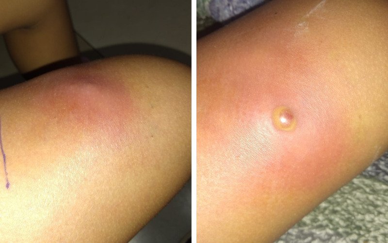 “Bichinho com a cauda para cima”: Menina de 7 anos é picada por escorpião-preto em Novo Hamburgo