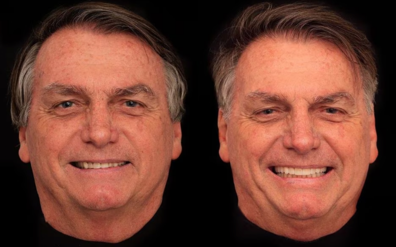 Bolsonaro fez harmonização facial? Entenda procedimento estético de R$ 84 mil realizado no ex-presidente