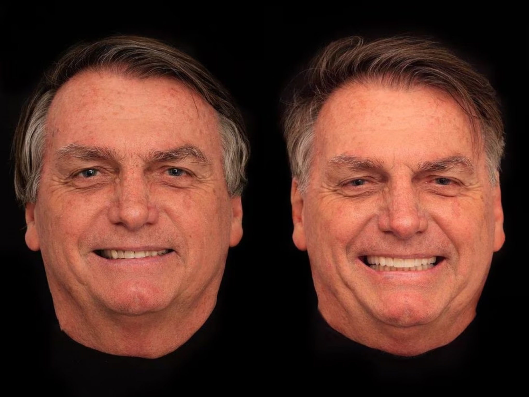 Bolsonaro fez harmonização facial? Entenda procedimento estético