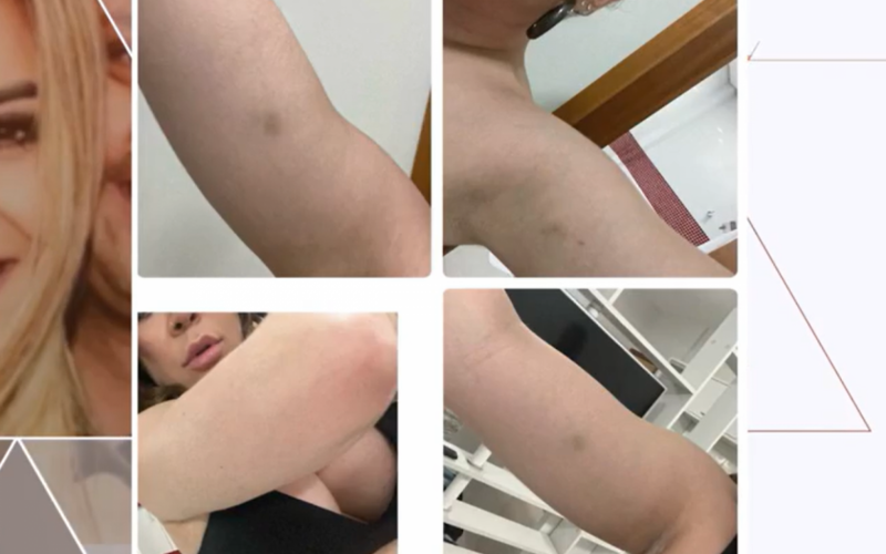 Naiara Azevedo mostrou ao Fantástico fotos de hematomas | Jornal NH