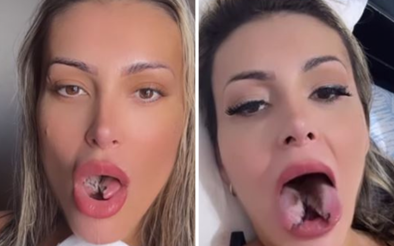 Andressa Urach fez bifurcação na língua | abc+